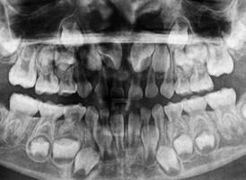 Blandingstandsæt røntgen (tandskifte)